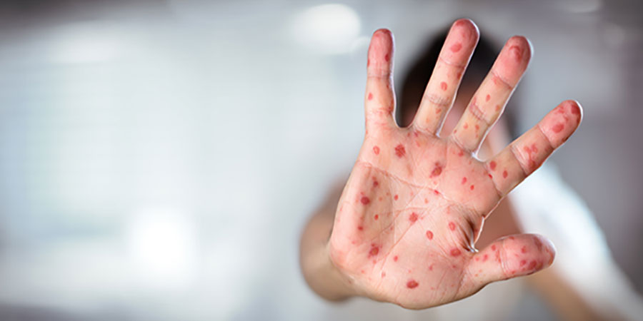 Measles Outbreak Taking Over The US